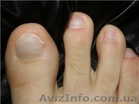 Наращивание ногтей на НОГАХ!!! - <ro>Изображение</ro><ru>Изображение</ru> #1, <ru>Объявление</ru> #632879